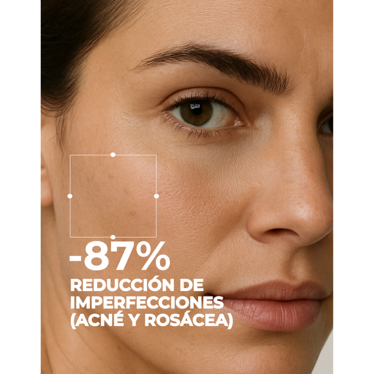 Segle Set Tratamiento Antiacné-Rosácea 2 x 30 ml
